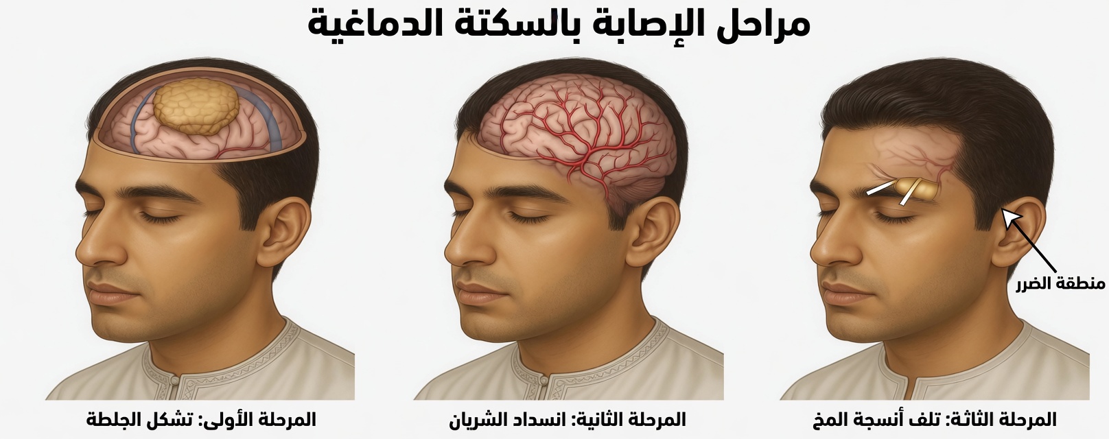 لا تفوّت هذه العلامات التحذيرية الثماني المبكرة لورمٍ في الدماغ – فالتعرّف عليها قد ينقذ حياتك