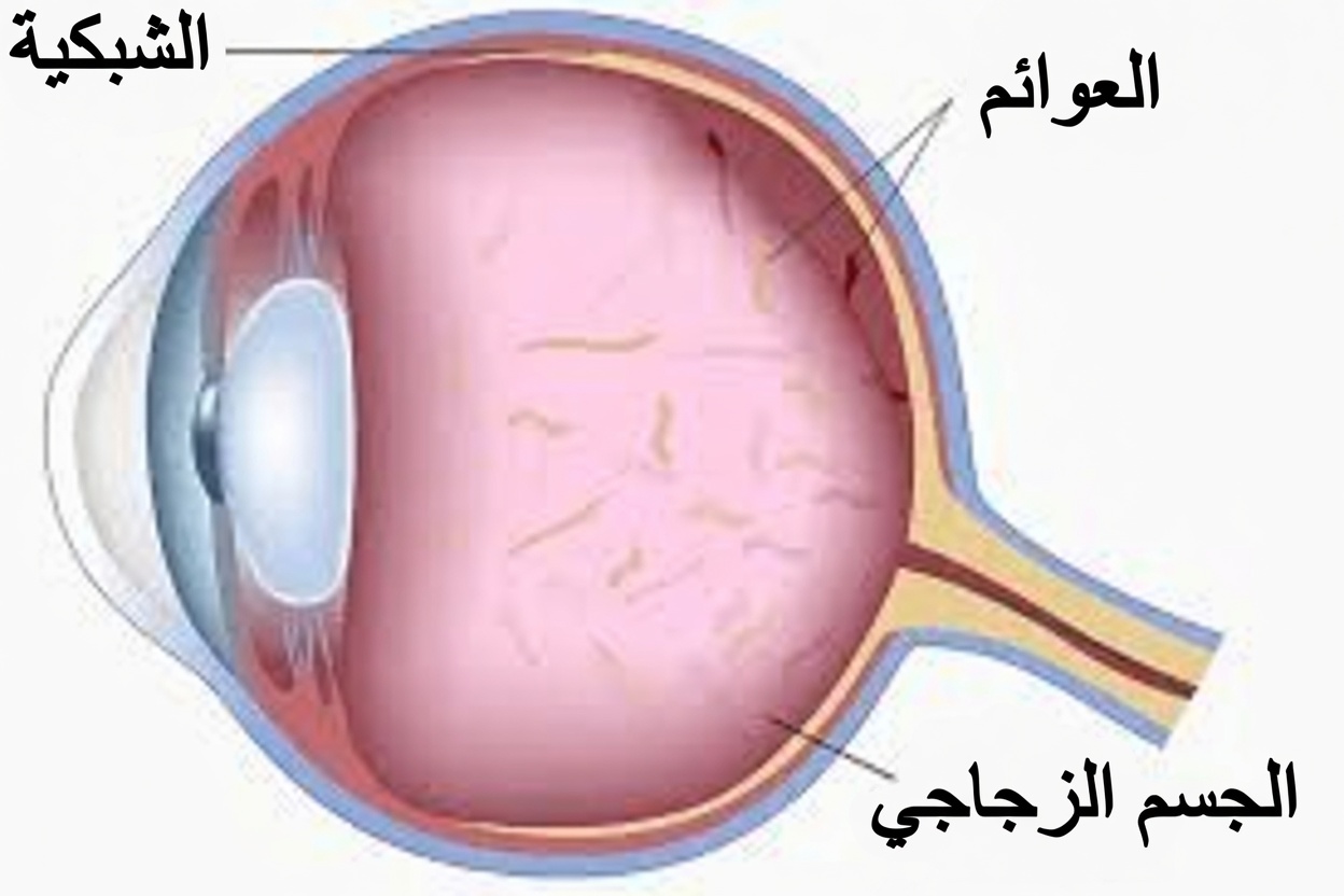 ماذا تفعل إذا بدأت ترى عوائم العين: دليل مفيد من طبيب عيون