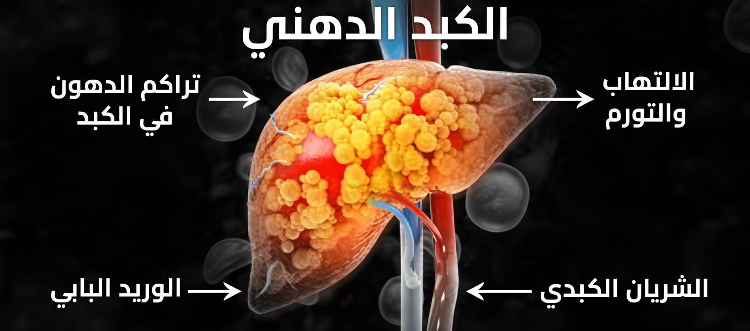 ما هي أكثر العلامات شيوعًا لمرض الكبد الدهني؟ التعرّف على التعب ومؤشرات مبكرة أخرى