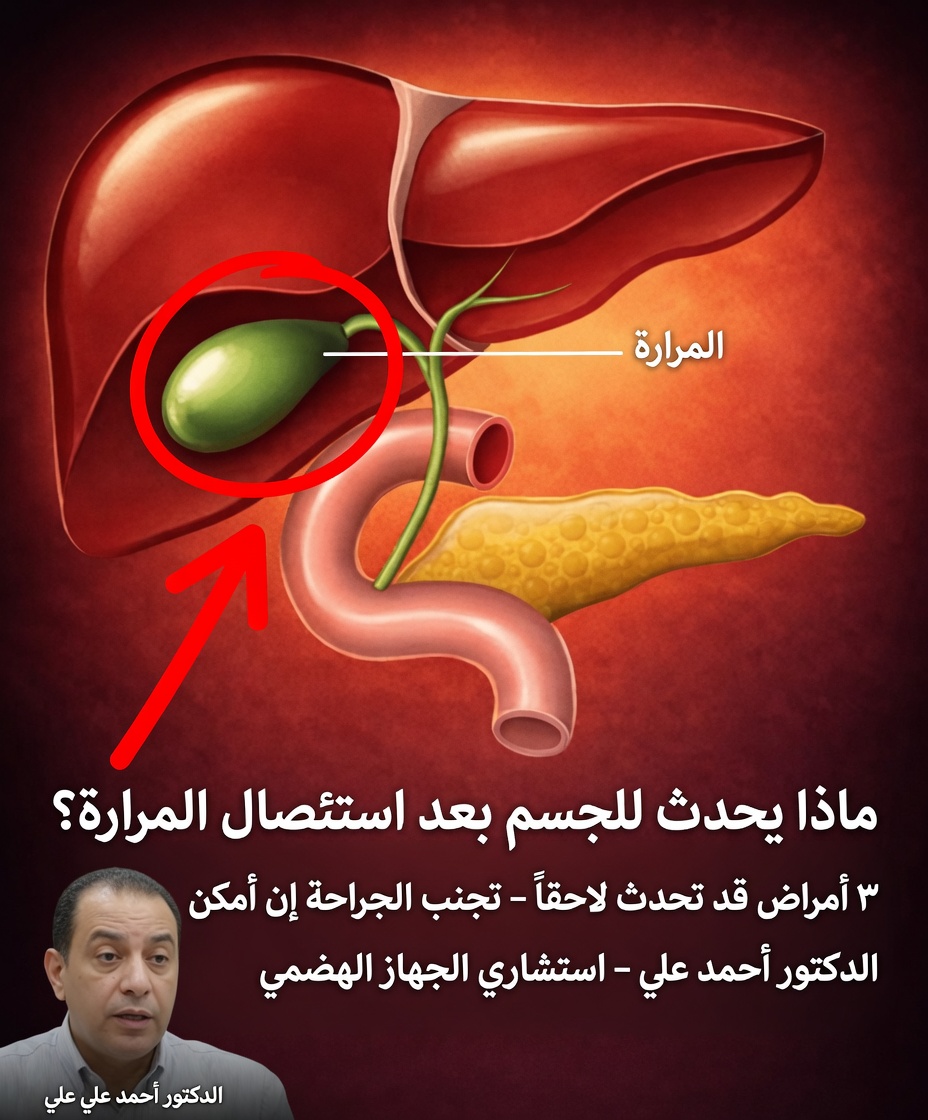 ماذا يحدث لجسمك بعد إزالة المرارة؟ 3 حالات محتملة ونصائح يجب مراعاتها قبل الجراحة