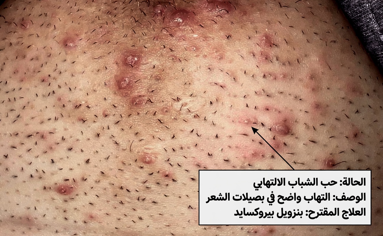 توقّفي عن الحلاقة: استكشاف حيلة إزالة الشعر الشائعة بالبصل ومعجون الأسنان