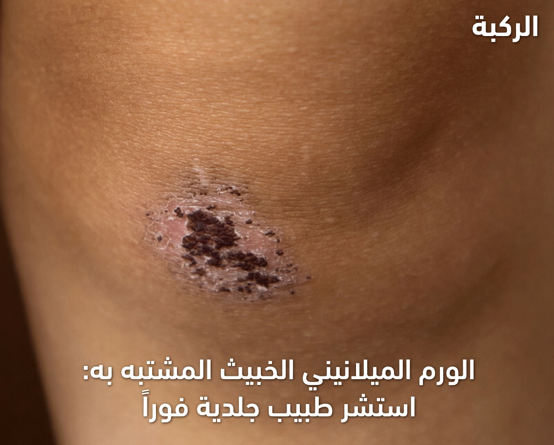 هل يمكن أن يكون جسمك يتوسل للحصول على المزيد من فيتامين د؟ اكتشف هذه العلامات الثماني الغريبة