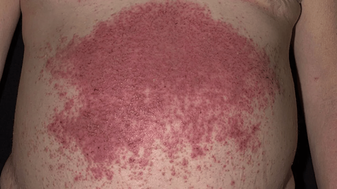 ماذا تفعل إذا كان لدى الأم طفح جلدي فقاعي يلتف حول جانبها: نصائح للراحة في المنزل أثناء انتظار قسم الطوارئ