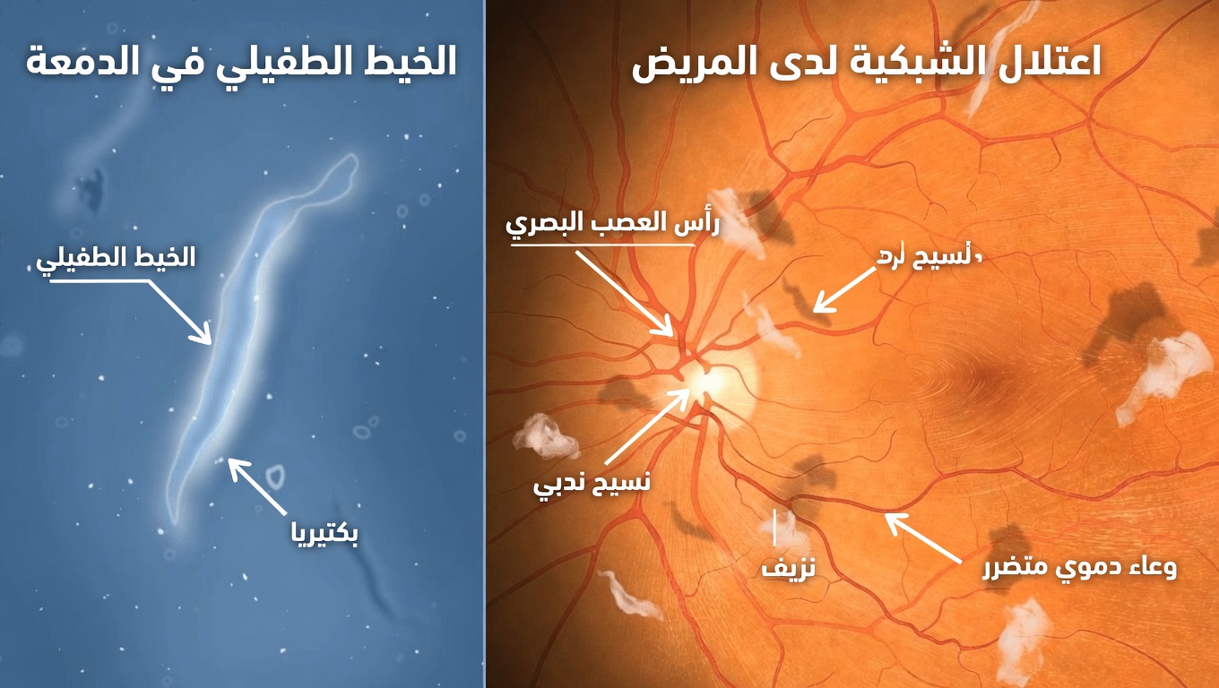 عوائم مفاجئة في العين مع ومضات أو ظل؟ دليل عملي للرعاية العاجلة للعين