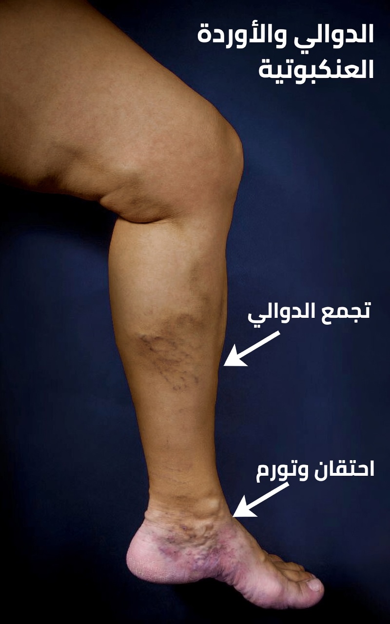 متى قد تشير الأوردة البارزة إلى القصور الوريدي المزمن أو مشكلات القلب والرئتين أو خطر الجلطات