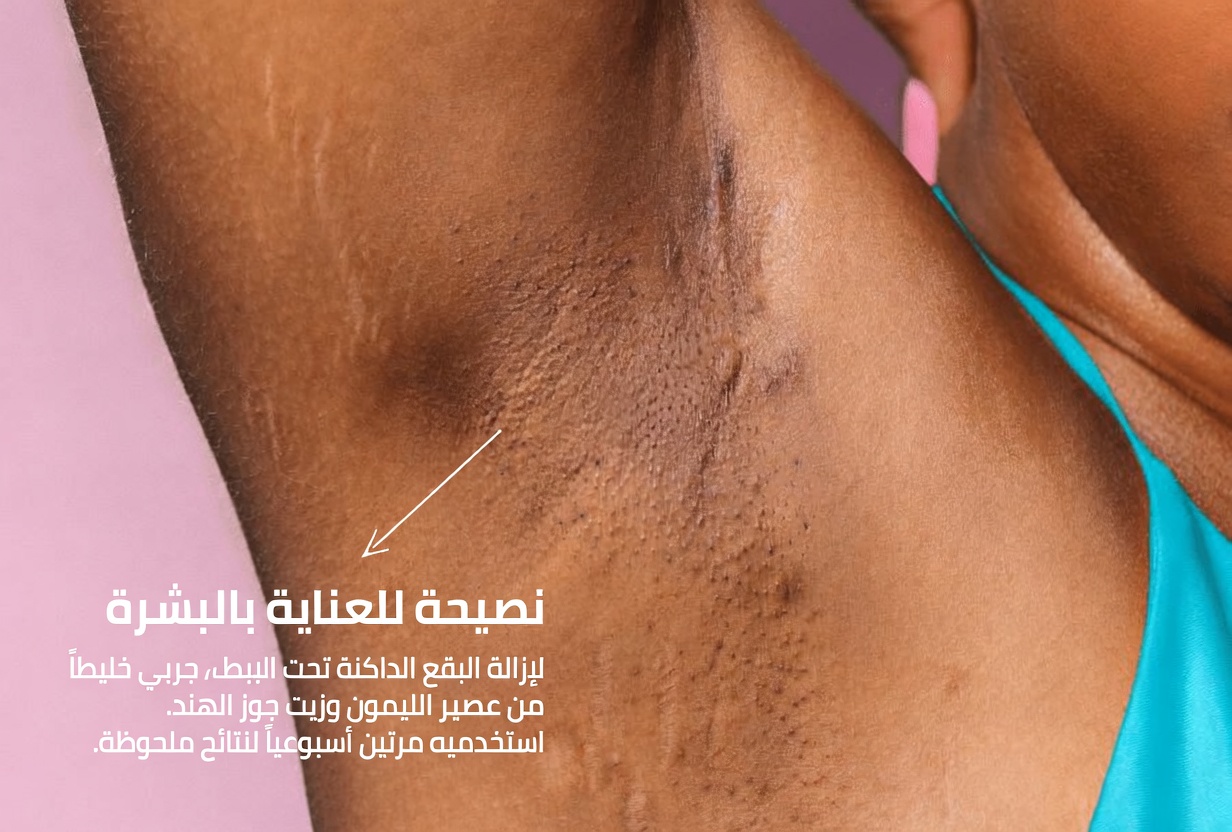 الإبطان الداكنان؟ اكتشف علاجات منزلية آمنة وطرقًا حقيقية لتفتيحهما طبيعيًا