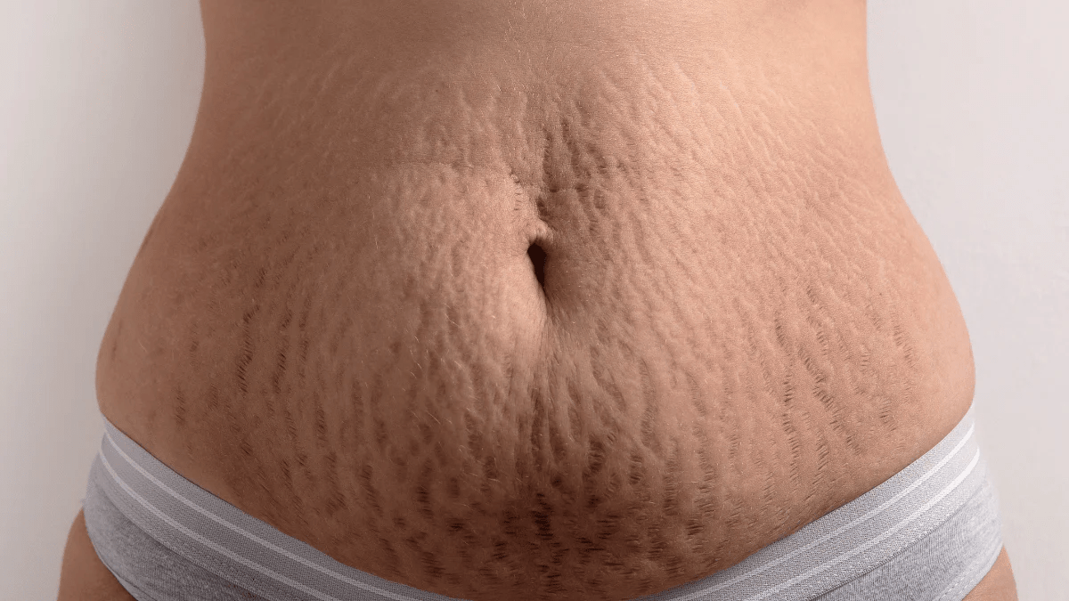 فهم علامات التمدد: الأسباب الشائعة واستراتيجيات العناية المنزلية العملية لصحة البشرة