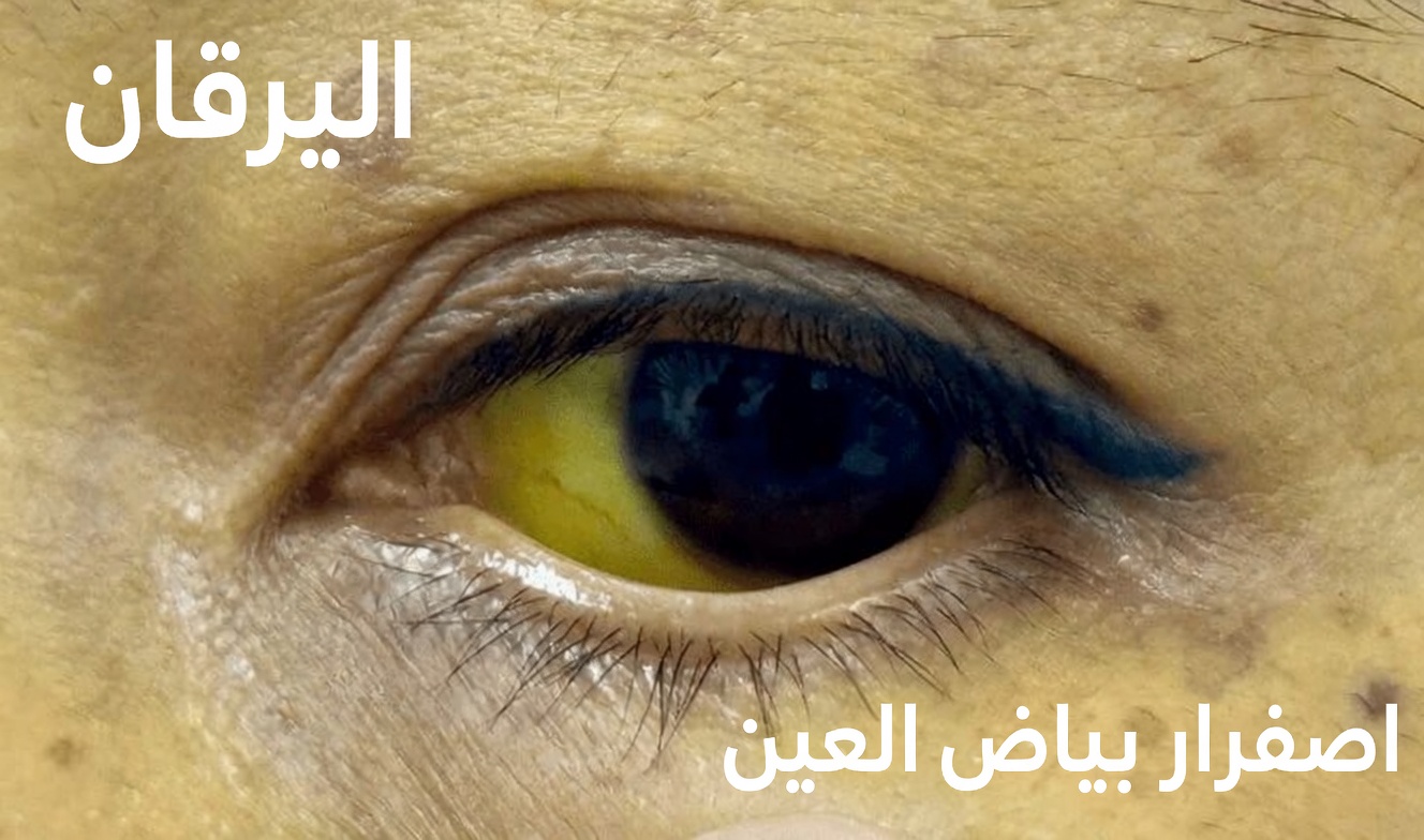 10 علامات تحذيرية لسرطان البنكرياس لا ينبغي تجاهلها أبداً