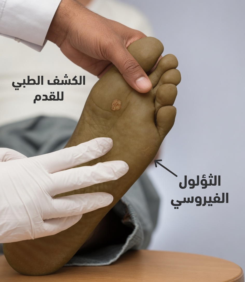 هل يمكن أن يساعد بيروكسيد الهيدروجين في علاج الثآليل؟ استخدامات عملية، نصائح للسلامة، وما يمكن توقعه في المنزل