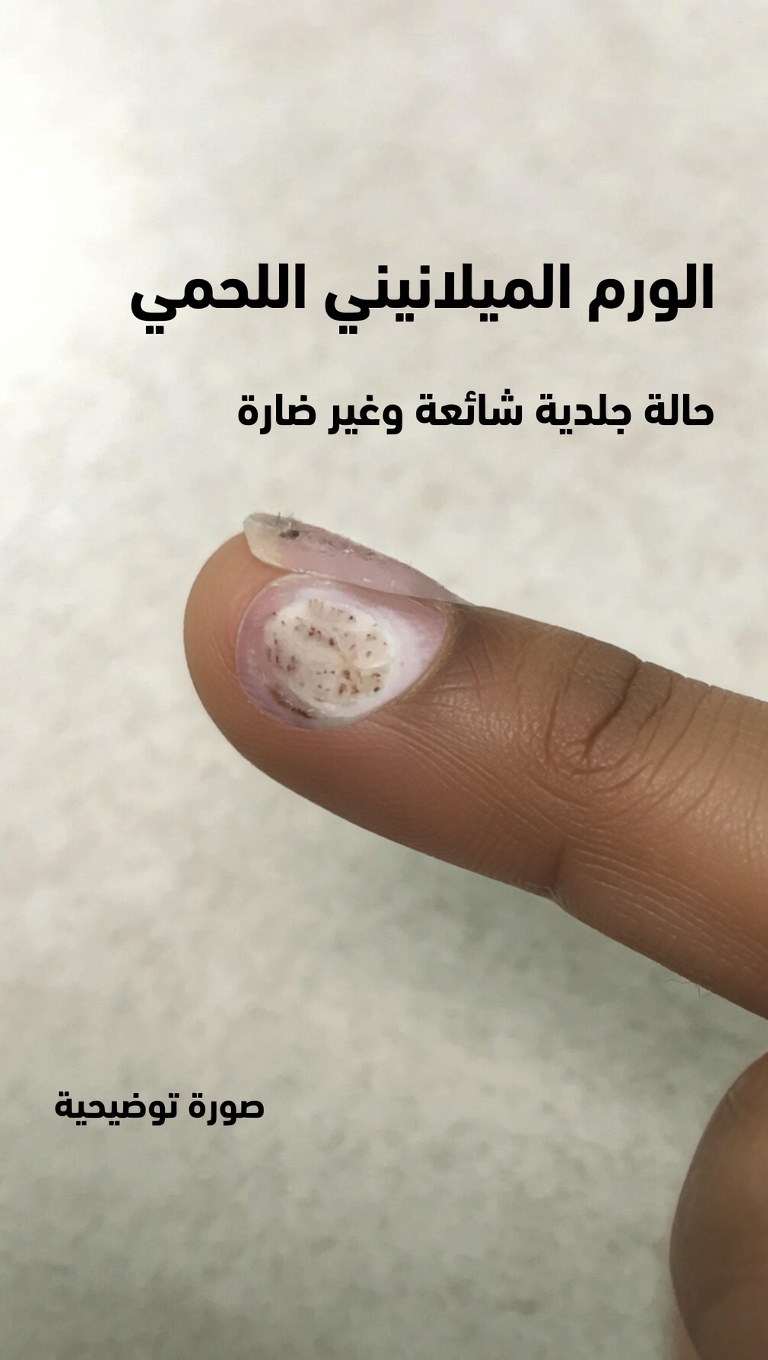 هل يمكن أن يساعد بيروكسيد الهيدروجين في علاج الثآليل؟ استخدامات عملية، نصائح للسلامة، وما يمكن توقعه في المنزل