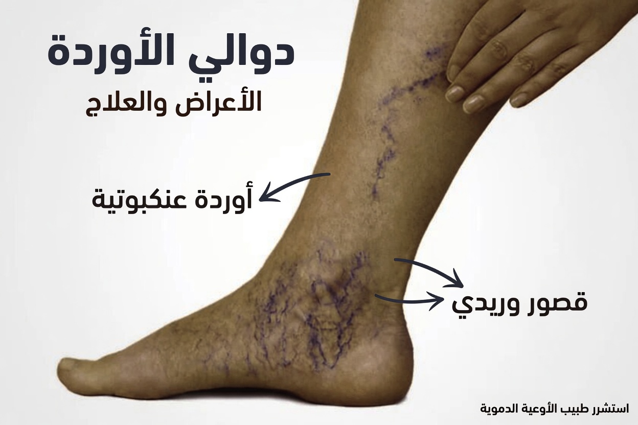 10 عادات طبيعية في نمط الحياة لدعم الدورة الدموية في الساقين وتخفيف انزعاج دوالي الساقين