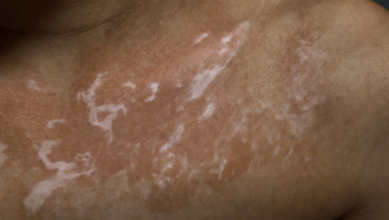 لماذا تظهر بقع بيضاء على بشرتك؟ الأسباب الشائعة وما يجب معرفته