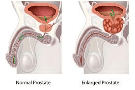 لماذا قد يؤدي تفويت فحوصات البروستاتا الدورية إلى زيادة خطر الإصابة بسرطان البروستاتا لدى الرجال فوق سن الأربعين