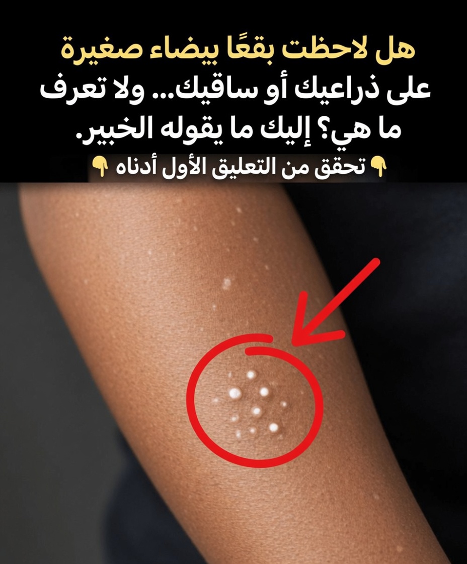لماذا تظهر بقع بيضاء على جلدك؟ الأسباب الشائعة وما يجب معرفته