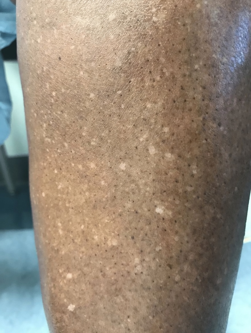 لماذا تظهر بقع بيضاء على جلدك؟ الأسباب الشائعة وما يجب معرفته