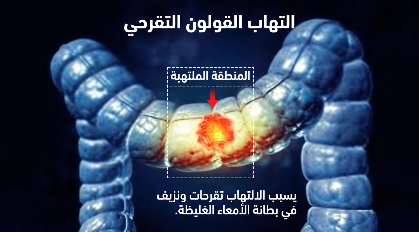 هل يمكن لهذا النهج البحثي الجديد أن يغيّر فهمنا لخلايا سرطان القولون؟