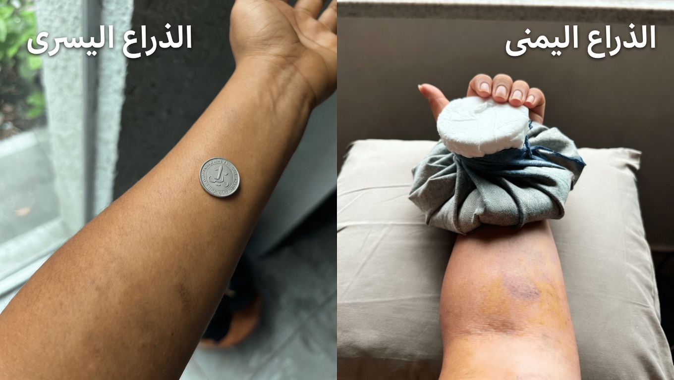كدمات أرجوانية داكنة تستمر في الظهور على ذراعيّ – ماذا يمكنني أن أفعل أثناء انتظاري لمراجعة الطبيب؟