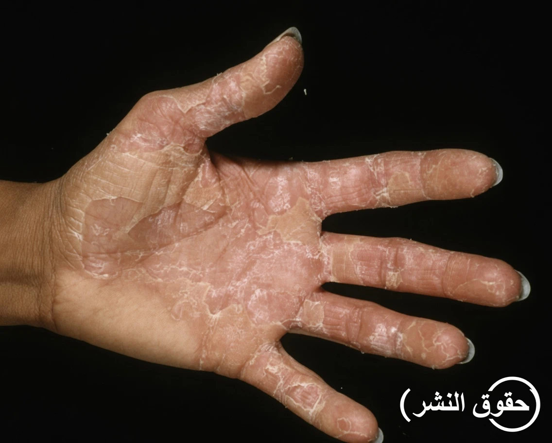 ماذا لو كان هذا الجلد المتقشر والمتساقط على يديك يحاول أن يخبرك بشيء مهم؟