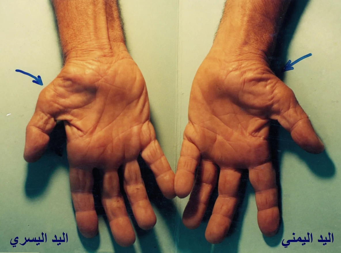 لماذا تشعر بخدر وتيبّس في يدك؟ الأسباب الشائعة ومتى يجب الانتباه