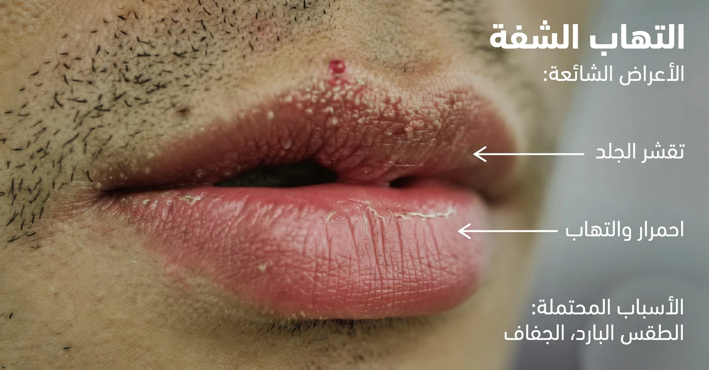 ما أسباب ظهور بقع بيضاء على شفتيك؟ الأسباب الشائعة ومتى يجب الانتباه