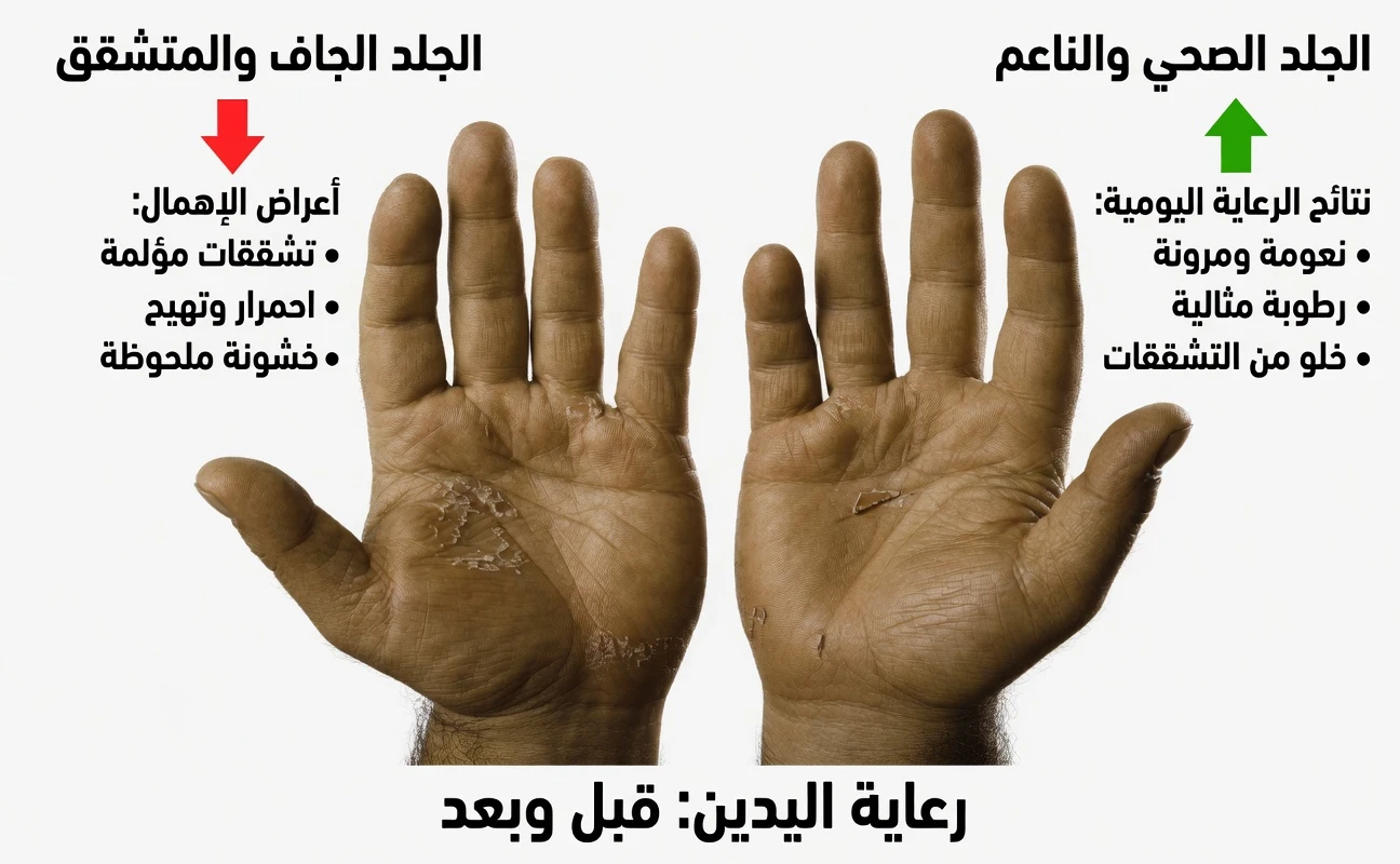 إذا ظهر هذا على يديك، فلا تتجاهله: العلامات المبكرة لالتهاب جلد اليدين التي تحتاج إلى معرفتها