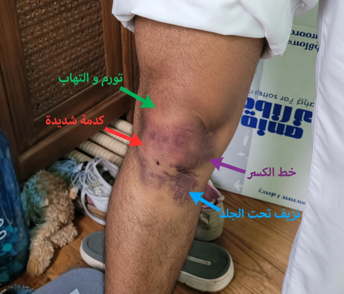 10 علامات تحذيرية خفية لسرطان البنكرياس لا ينبغي تجاهلها