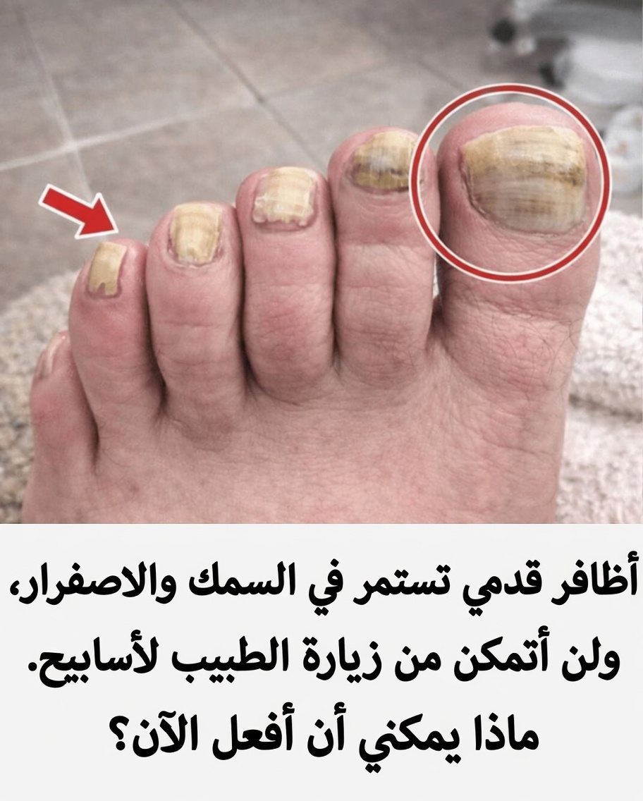 ماذا تفعل الآن إذا كانت أظافر قدميك تزداد سُمكًا وتتحول إلى اللون الأصفر (بينما تنتظر الطبيب)