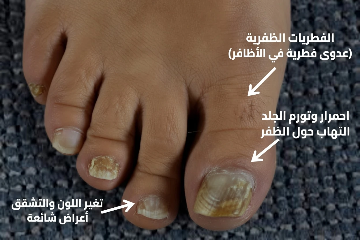 ماذا تفعل الآن إذا كانت أظافر قدميك تزداد سُمكًا وتتحول إلى اللون الأصفر (بينما تنتظر الطبيب)
