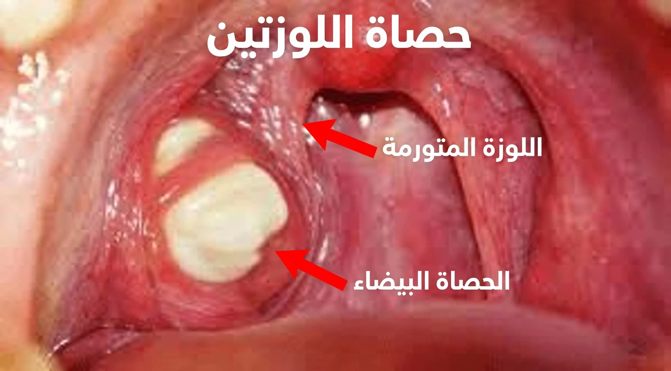 ما هي تلك «الحجارة» البيضاء ذات الرائحة الكريهة في فمك التي تسبب رائحة فم سيئة للغاية؟ الحقيقة حول حصوات اللوزتين