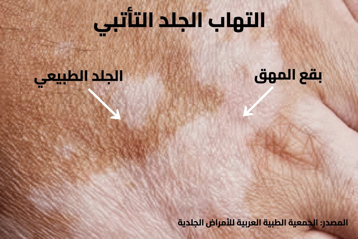 لماذا تظهر بقع بيضاء على بشرتك؟ الأسباب الشائعة وما يجب معرفته